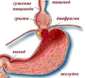 Hiatus hernia tünetei és kezelése, diéta, okai