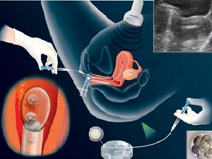 Implantarea embrionilor cu eco după implantare, în primele zile după plantarea cu eco, după eco senzație