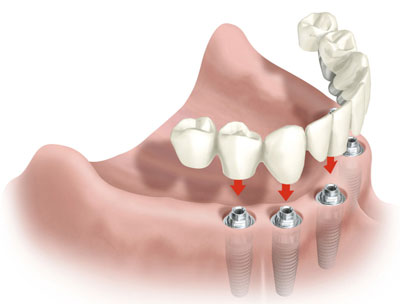 Імплантація зубів в розстрочку - установка імплантату в розстрочку (в кредит)