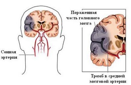 Ішемічний мікроінсульт головного мозку причини і симптоми хвороби