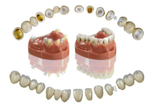 Ce sunt coroanele pe dinți?