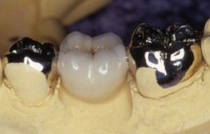 Ce sunt coroanele pe dinți?