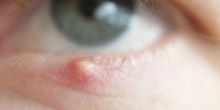 Як лікувати ячмінь на оці в домашніх умовах у дитини або дорослого ліками і народними