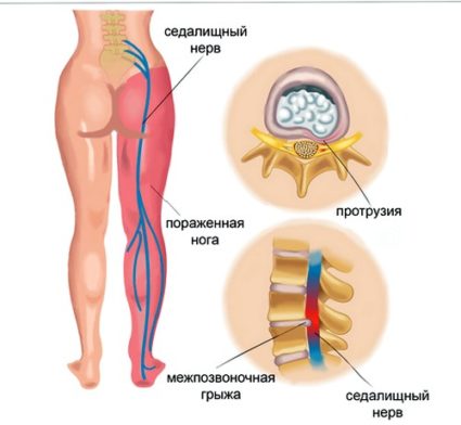 Як визначити і лікувати запалення сідничного нерва