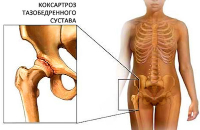 Як зупинити коксартроз кульшового суглоба