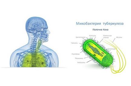 Ce este tusea cu tuberculoză