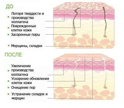 Care este cel mai eficient exfoliere de tot felul de peeling în studio, salonul de frumusețe din Sankt Petersburg