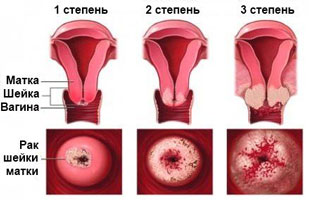 Як виглядає рак шийки матки - фото, відео