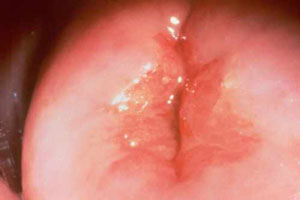 Cum arată cancerul de col uterin?