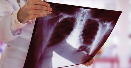 Кашель при туберкульозі особливості і симптоми