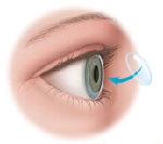 Кератопластика (пересадка рогівки ока) - все про операцію трансплантації