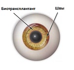 Кератопластика (пересадка рогівки ока) - все про операцію трансплантації