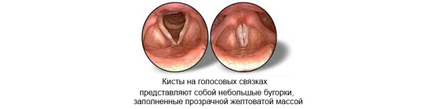 Кіста гортані і ларингоцеле