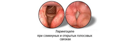 Кіста гортані і ларингоцеле