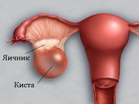 Chistul ovarian este un tratament conservator și chirurgical