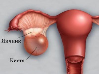 лечение на яйчниците киста е консервативна и хирургически