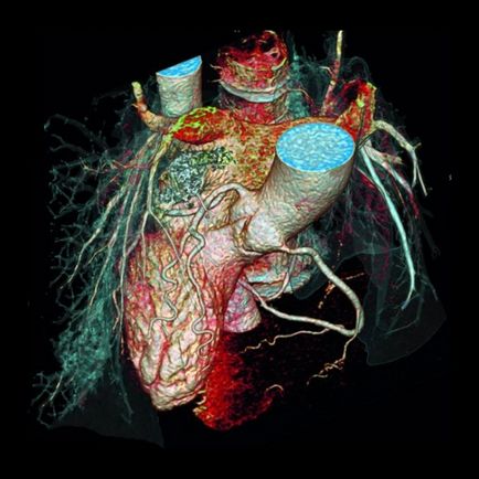 Tomografia computerizată a arterelor coronare, kt cu vase contrastante