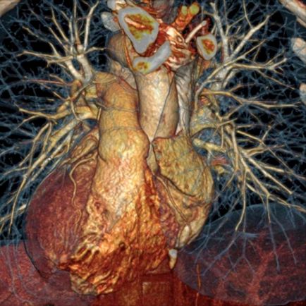 Tomografia computerizată a arterelor coronare, kt cu vase contrastante