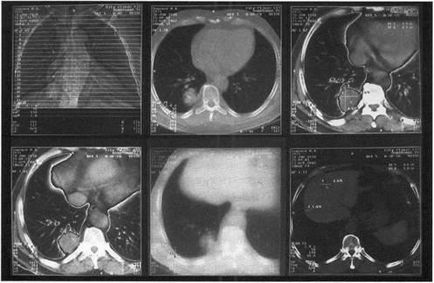 Комп'ютерна томографія (кт) і магнітно-резонансна томографія (МРТ) - показання та протипоказання
