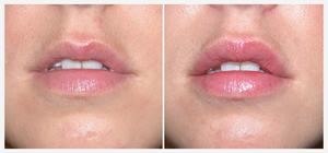 Corectarea și mărirea buzelor, plasticul contur cu acid hialuronic, înainte și după fotografii
