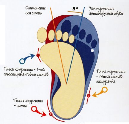 Clubfoot la copii