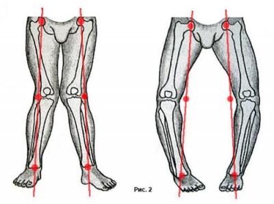 Clubfoot la copii