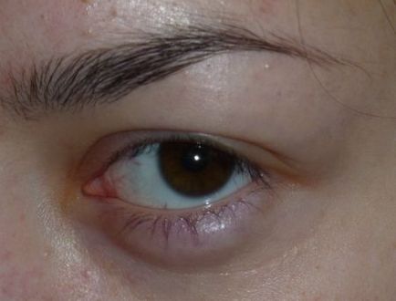 Ochii roșii și cauzele și tratamentul bolii