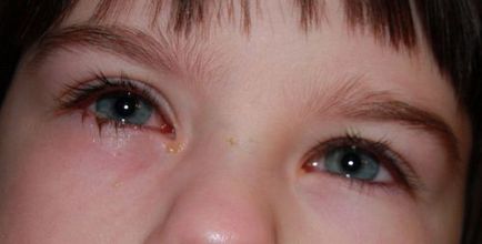 Червоний очей і гноїться причини і лікування захворювання