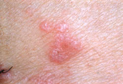 lichen planus