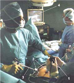 Colecistectomia laparoscopică