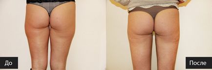 Costul liposuctiei cu laser la chirurgie, preturi la moscow - clinica