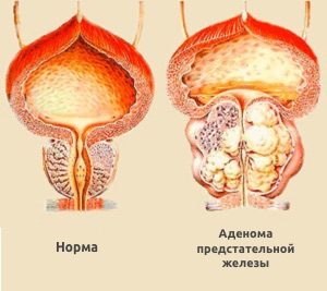 Tratamentul adenomului prostatic și prostatitei pe aparatul 