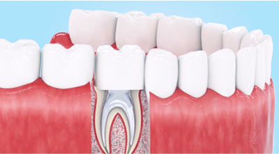 Tratamentul dinților 
