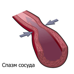 Tratamentul spasmei vaselor cerebrale cu pastile