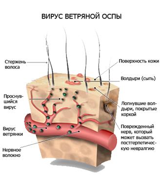 Лишай на нозі і інших частинах тіла лікування, профілактика