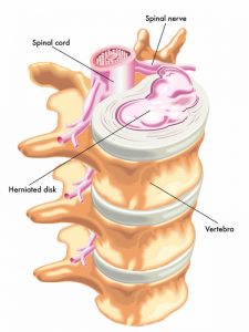 Hernia intervertebrală - descriere, diagnostic, tratament în Israel