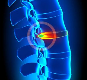 Hernia intervertebrală - descriere, diagnostic, tratament în Israel