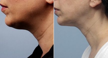 Mezoterapia gâtului și eficienței celui de-al doilea bărbat, recenzii și preț