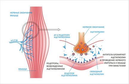 Myasthenia általános információk a betegség (myasthenia gravis) Myasthenia általános információt a betegségről