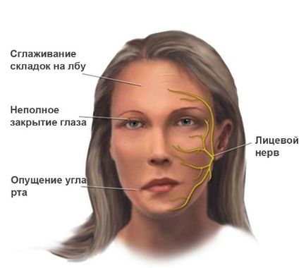 Міастенія загальні відомості про хвороби