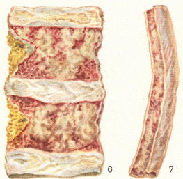 A myeloma multiplex (rustitskogo betegség, myeloma, mielomatoz, retikuloplazmotsitoz)