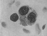 Mielom (boală rustică, mielom, mielomatoză, reticuloplasmocitoză)