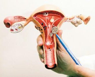Miomul uterului