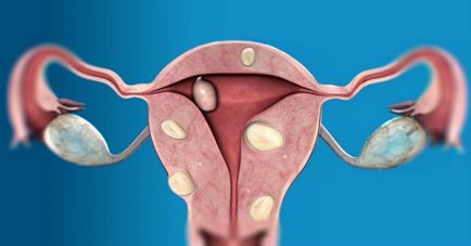 Multiple miomul uterin