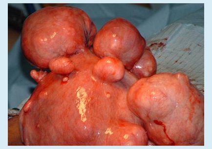 Fibroide uterine multiple cauze și semne, fotografii, caracteristici în timpul sarcinii, tratarea nodurilor