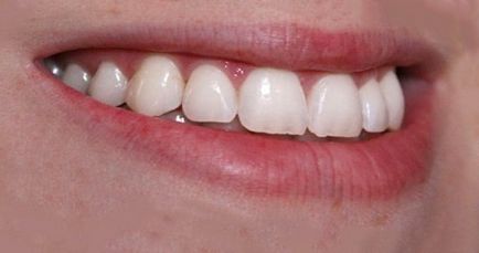 Чи можна відбілити зуби яблучним оцтом, очищення організму здоров'я людини