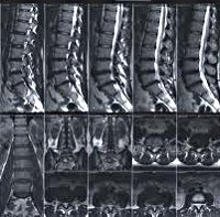 MRI a gerinc (összesen) - árak Moszkvában talált 183 árakba (hatékonyság gerinc sebészeti beavatkozás) MRI a gerinc (összesen) - árak Moszkvában talált 183 árak