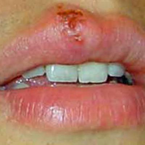Народні засоби від герпесу на губах - інфекційні захворювання - каталог статей - народні