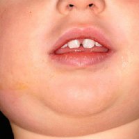 A nem-specifikus mumpsz gyermekeknél