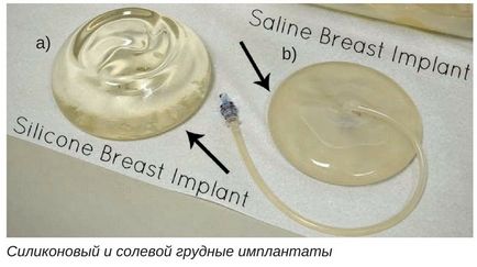 Indiferent dacă este necesară schimbarea implanturilor mamare după mamografie